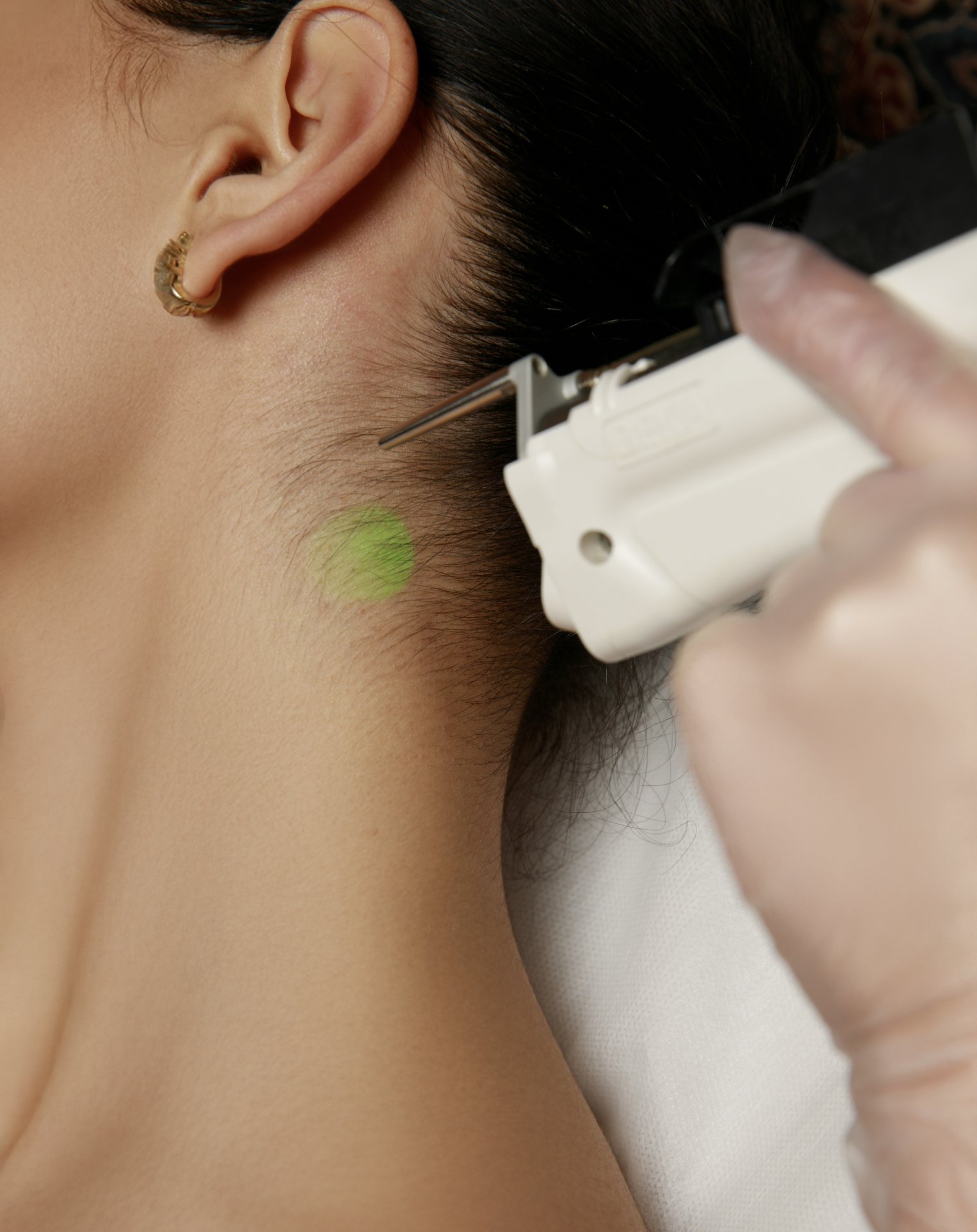 LASER DEKA MOTUS AX | BACK OF THE NECK