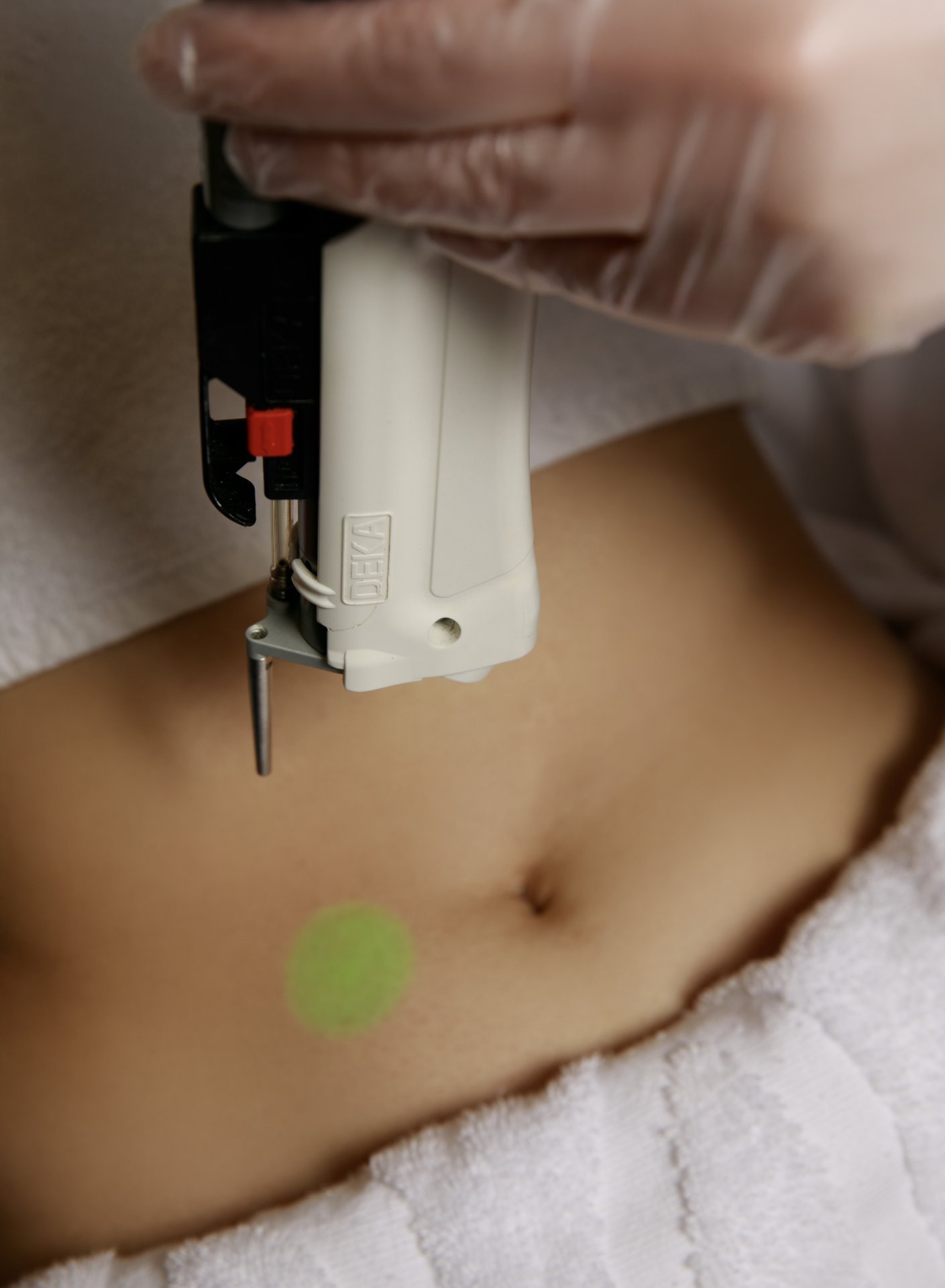 LASER DEKA MOTUS AX | ABDOMEN