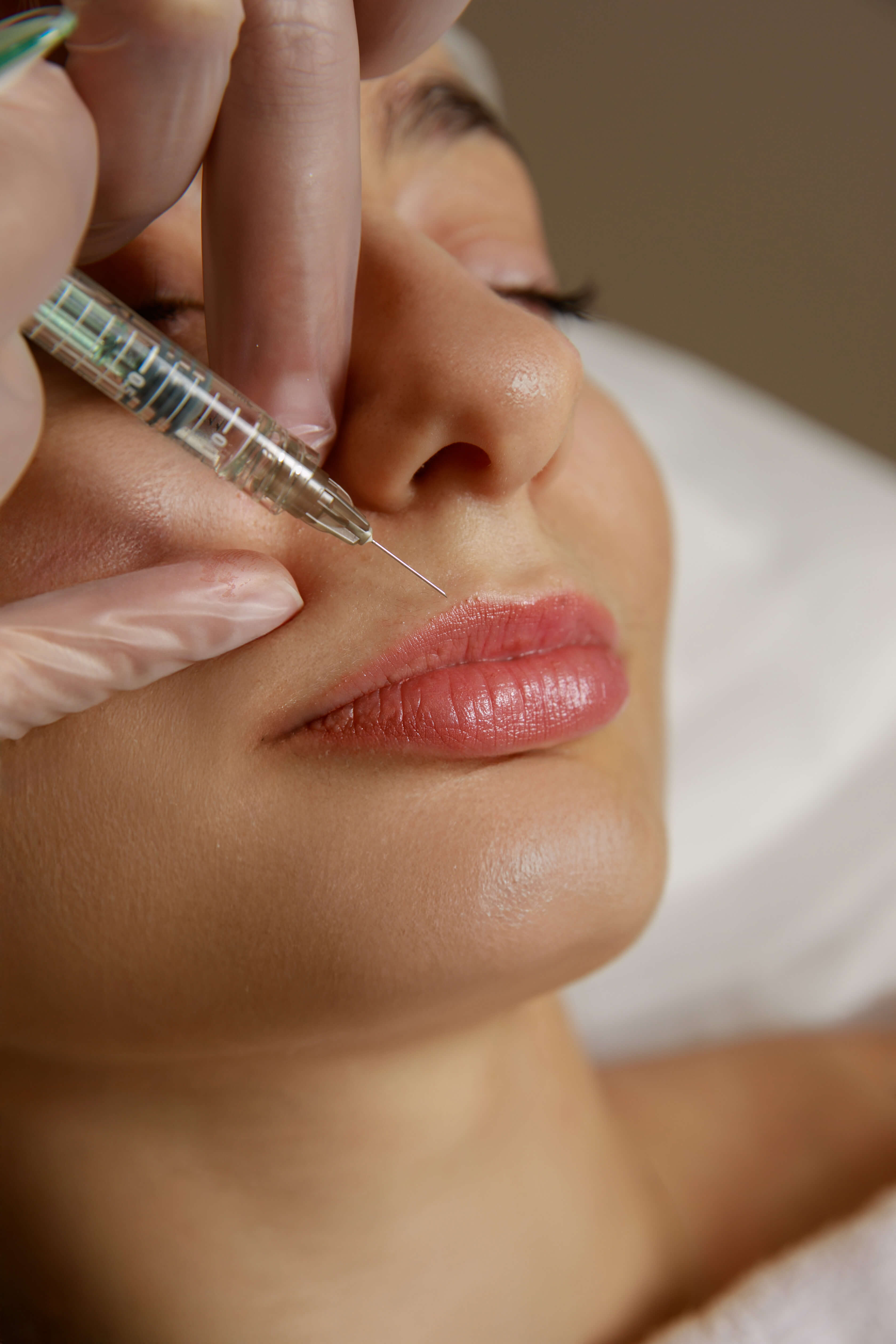 FILLER |  JUVEDERM ULTRA SMILE