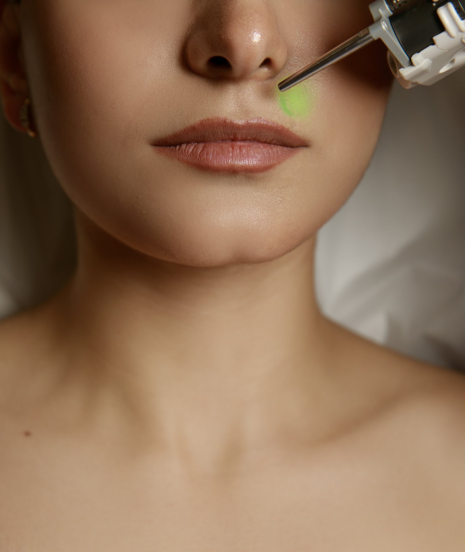 LASER DEKA MOTUS AX | UPPER LIP