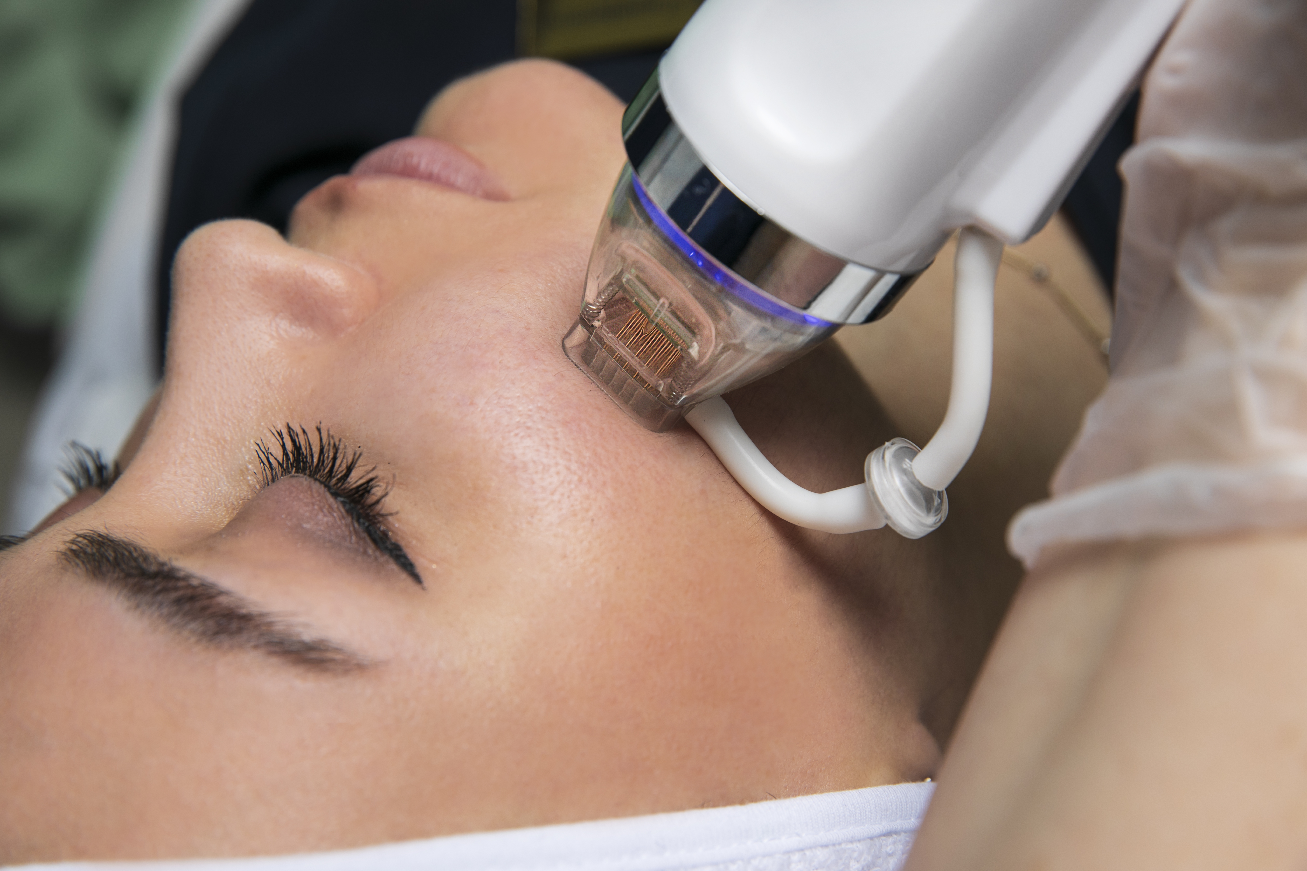 RF MICRONEEDLING | MEDIUM AREA